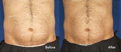 VelaShape Body Contouring: Pros, Cons & Cost .